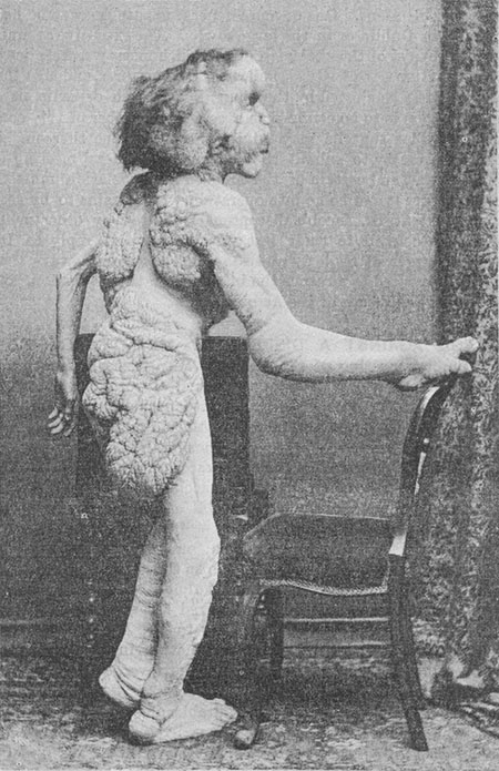Joseph Merrick, el hombre elefante (1889)